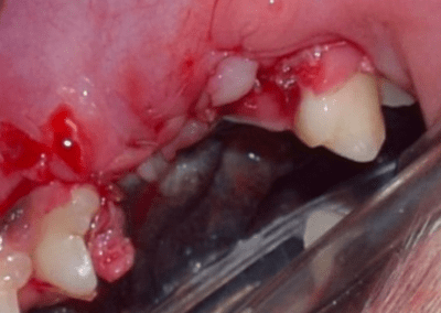 After teeth extraction image